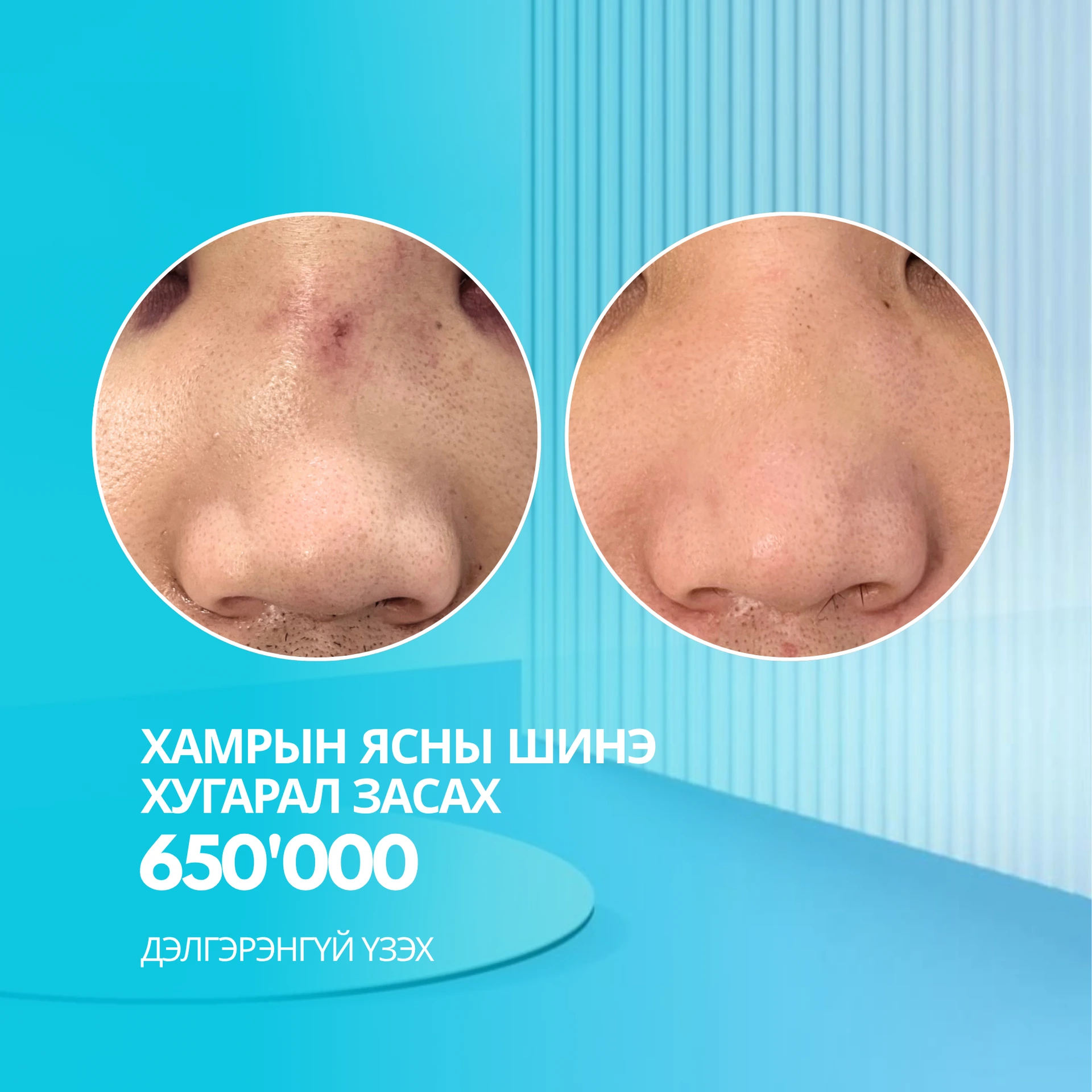 Хамрын ясны шинэ хугарал засах